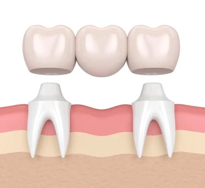 Dental Bridge Repair