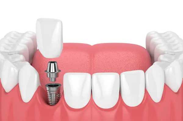Dental Implants
