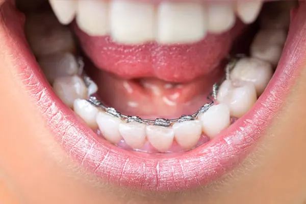 Lingual Braces
