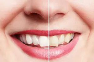 Gainesville, TX, dentist offers teeth whitening 