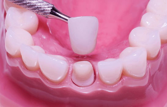 Dental Crown Replacement