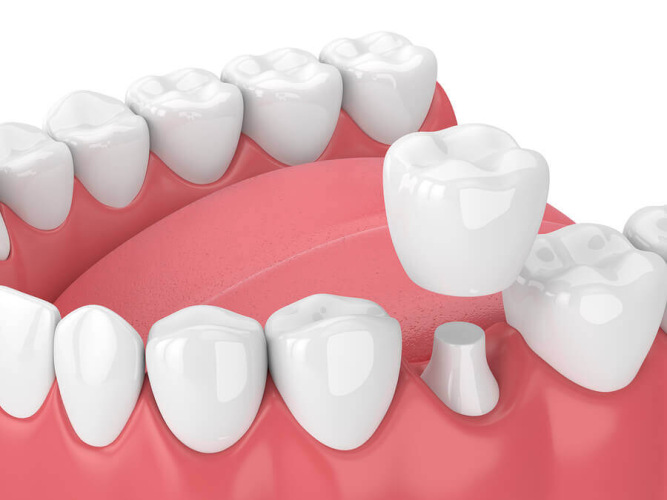 Dental Crown Repair