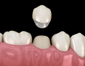 How a Dental Crown Benefits Your Smile