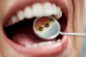 lingual braces and accelerated orthodontics in Gainesville, TX